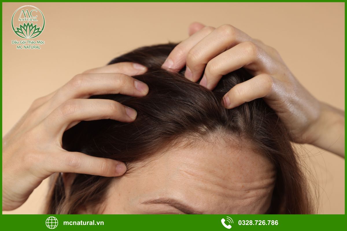 Tình trạng da đầu nhạy cảm và rụng tóc sau sinh là gì?